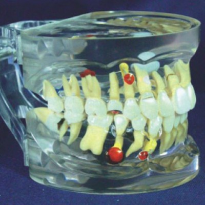 益联医学透明牙体综合病理模型 牙齿模型 牙齿治疗教学模型